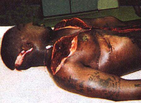 tupac death body